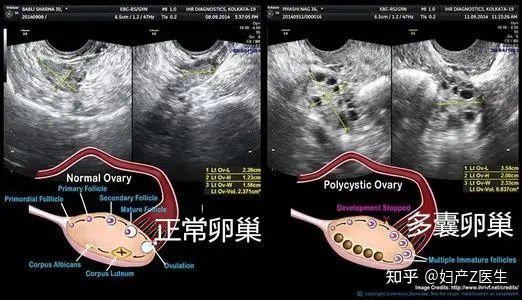 多囊试管婴儿成功率低吗